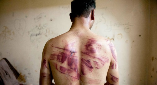 Hombre con marcas de tortura en la espalda 